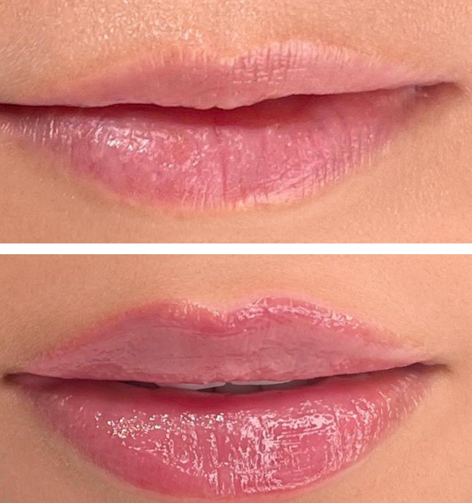 Gloss injection