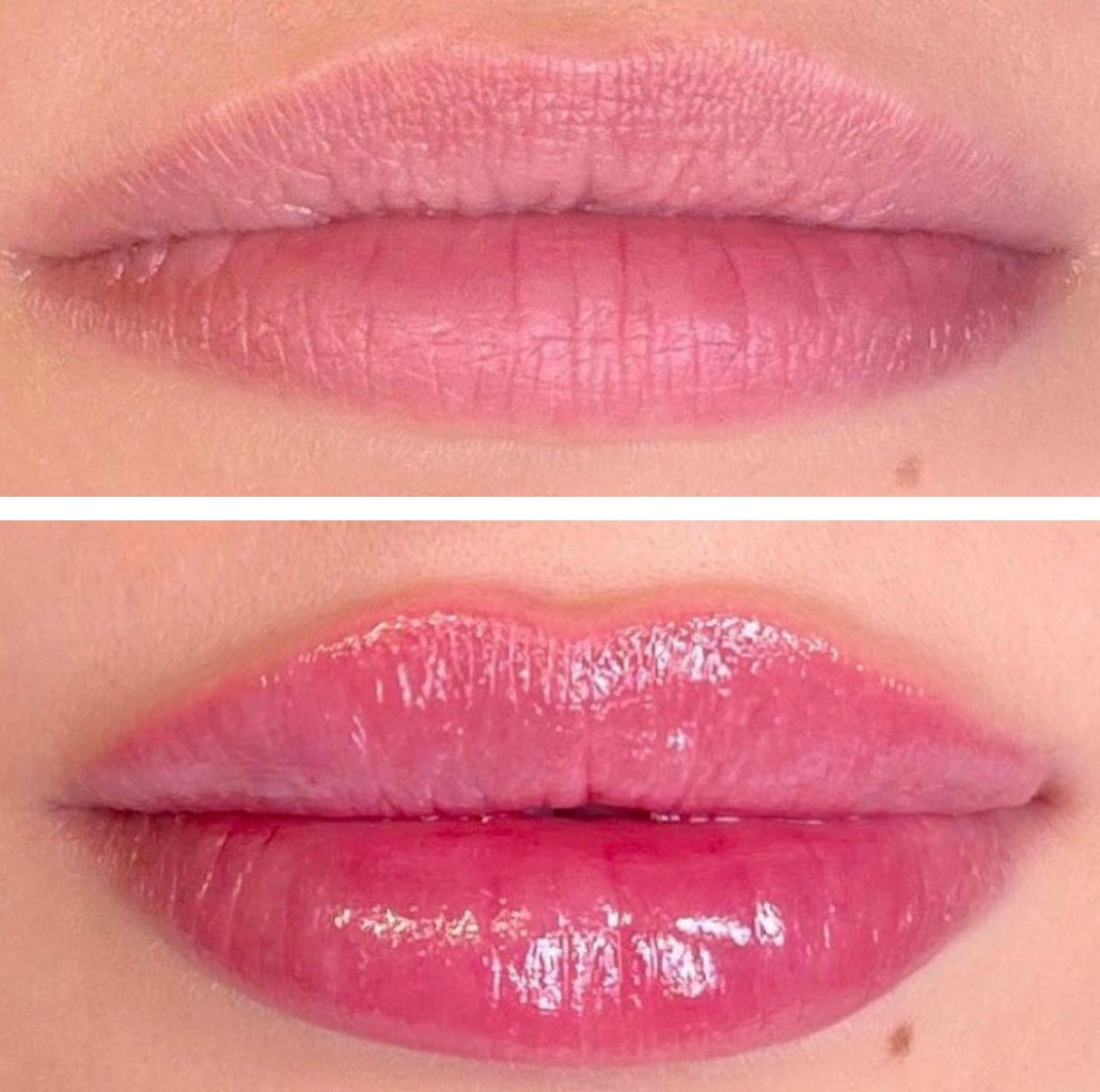Gloss injection