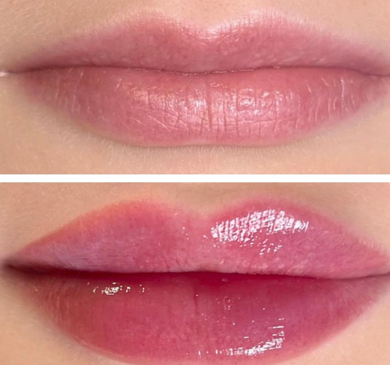 Gloss injection